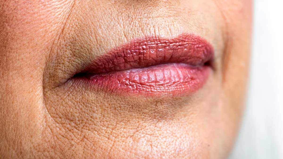Tormented by Unwanted Lip Lines? Doctor Tells Causes And Treatment in Detail